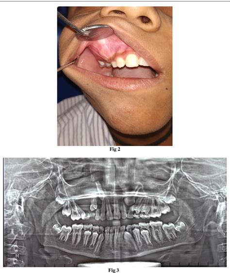 Figure 3 From Maxillary Dentigerous Cyst A Case Report And Brief