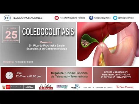 Coledocolitiasi Causes Tipus I Factors De Risc Metge