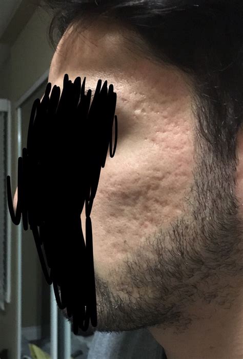 25 Yo With Acne Scars On Cheeks And Temple Need Advice On Treatment
