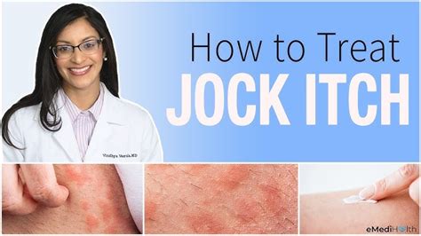 Jock Itch Tinea Cruris Treatment
