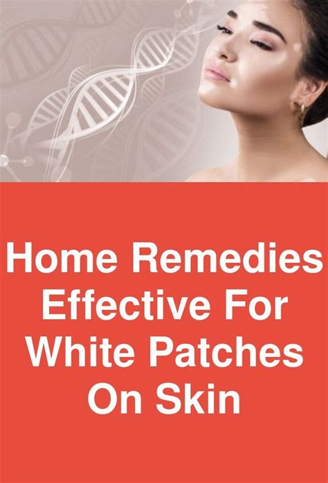 Home Remedies Effective For White Patches On Skin This Article Points