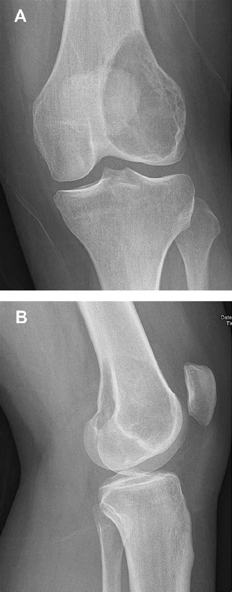 Radiological Appearance Of Giant Cell Tumor Of Bone Of Distal Femur