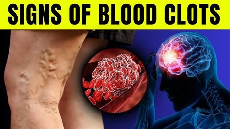 Top 9 Warning Signs Of Blood Clots Youtube