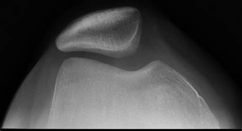 Weak In The Knees Patellar Dislocation Radiology Key