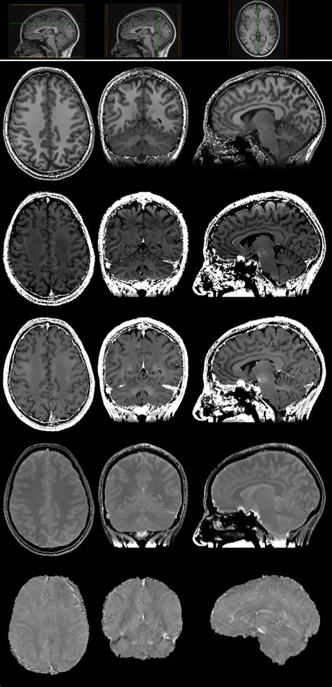 Axial Left Coronal Middle And Sagittal Right Brain Slices Of R Download Scientific