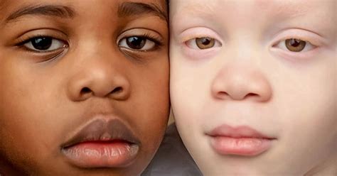 Twins With Different Skin Colors Astonished Their Mom When They Were