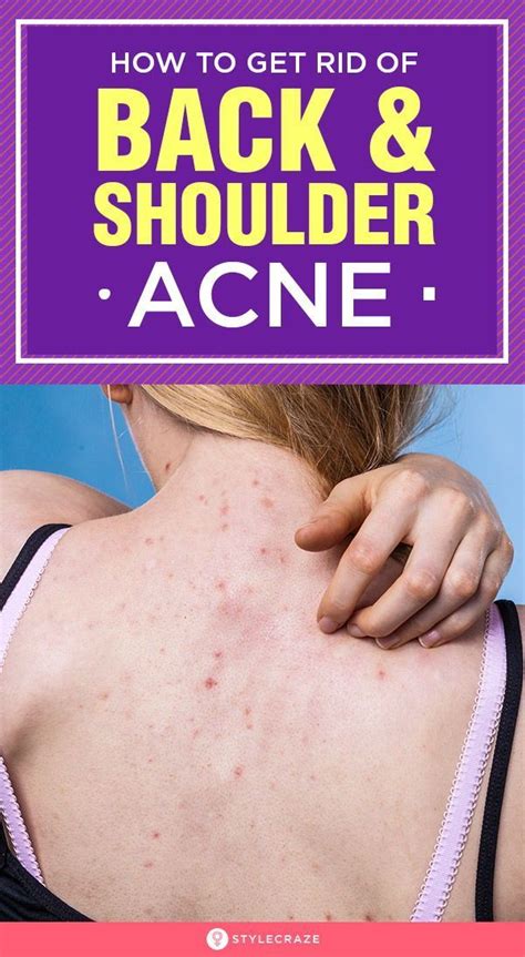 Home Remedies For Back Acne Causes Treatment And Prevention Tips