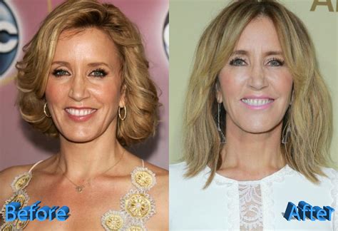 felicity huffman plastic surgery was it a good idea though