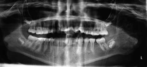Aneurysmal Bone Cyst Jaw