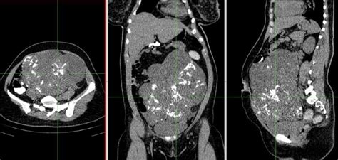 33 Years Old Female With Immature Teratoma Ct Scan Shows Images Of