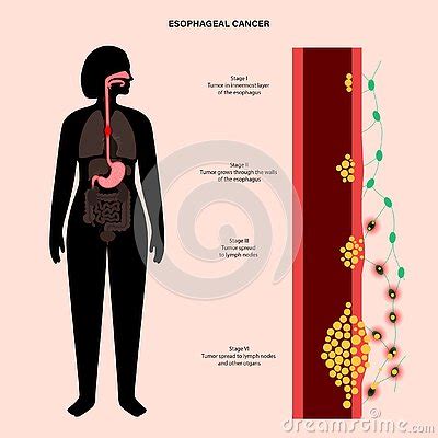 Esophageal Cancer Stages Vector Illustration Cartoondealer Com