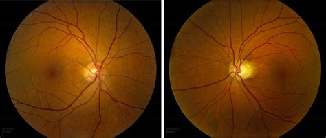 Dramatic Visual Recovery In Untreated Indirect Traumatic Optic Neuropathy