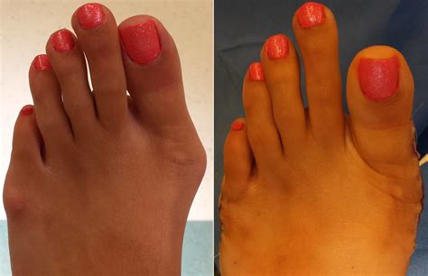 Gallery For Tailors Bunion Before And After