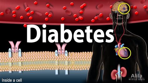 Diabetes Mellitus Symptoms Complication Pathology Of Type 1 And