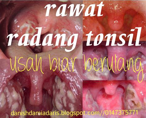 Operasi amandel atau tonsilektomi biasanya dilakukan untuk mengatasi tonsilitis atau radang. 3D health beauty supplement: KENALI TONSIL DAN RADANG ...