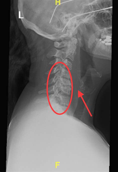 Cureus Acute Calcific Tendonitis Of The Longus Colli An Uncommon