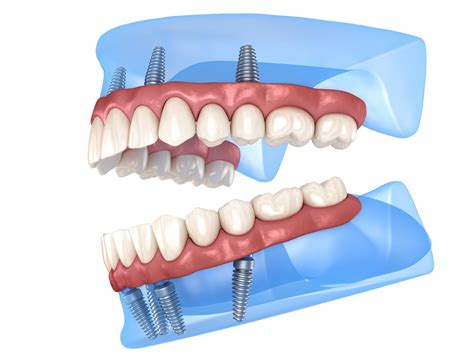 Implant Dentures With All On Four® Allen Tx