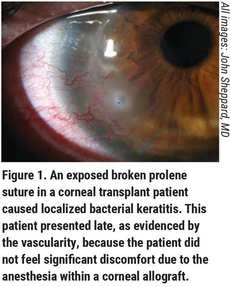 Solving The Puzzle Of Corneal Ulcers