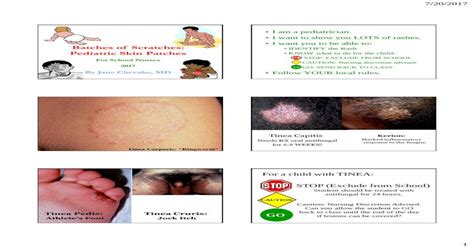 Batches Of Scratches Identify The Rash Pediatric Skin €¦ · Tinea
