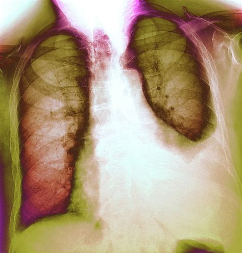 Lung Infection Photograph By Zephyrscience Photo Library Fine Art