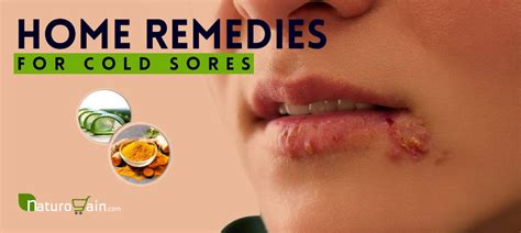 10 Best Home Remedies For Cold Sores That Work Fast Naturally