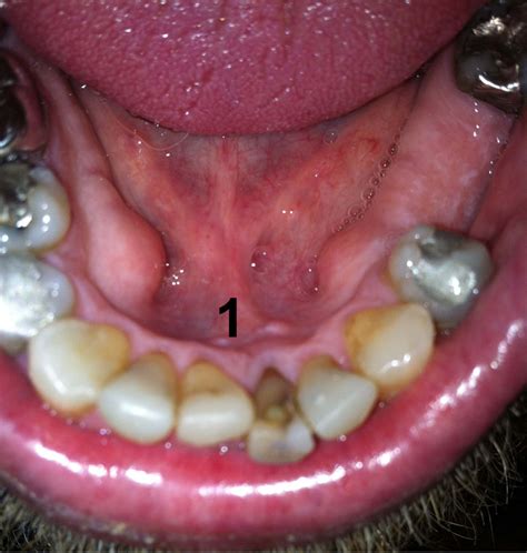 White Lump On Floor Of Mouth