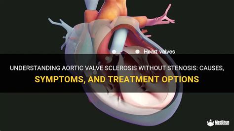 Understanding Aortic Valve Sclerosis Without Stenosis Causes Symptoms