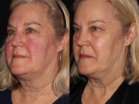 Bbl Photofacial Before And After Pictures Case 5 Chico Yuba City