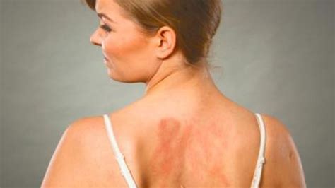 Alergia Al Sol Causas Sintomas Y Tratamientos Telecinco