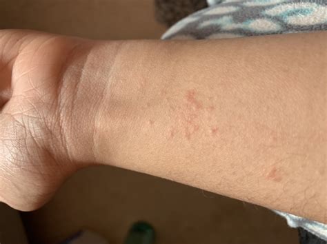 I Dont Know What Kind Of A Rash This Is Dermatology Forums Patient