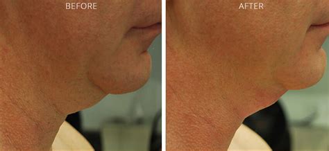 Non Surgical Neck Lift Ny Before And After Pictures