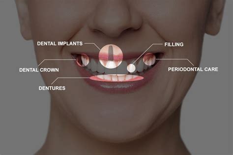 Full Mouth Reconstruction Recovery Troy Mi