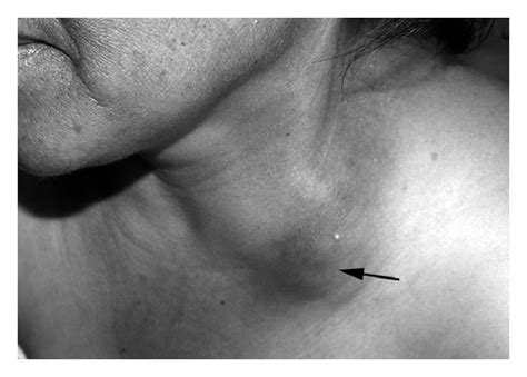 Enlarged Cervical Lymph Nodes In A Patient Case No 1 With