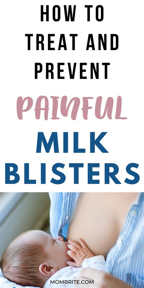 How To Treat And Prevent Milk Blisters Mombrite Milk Blister