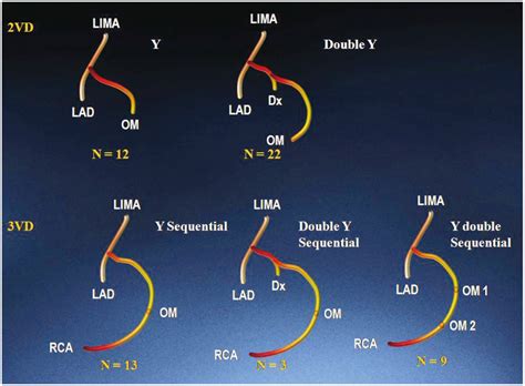 Смотреть что такое diagonal arteries в других словарях: Comparison of the Radial Artery and Saphenous Vein as Composite Grafts in Off-Pump Coronary ...