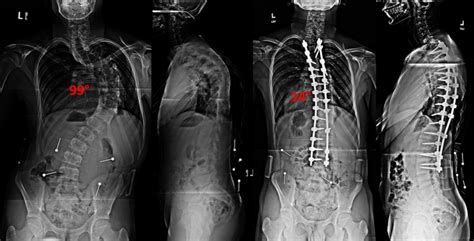 Spinal Fusion With Instrumentation Scoliosis And Spine Associates