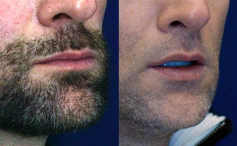 Before And After Male Lip Lift 2 Mm Of Skin Removal Dr Rodriguez