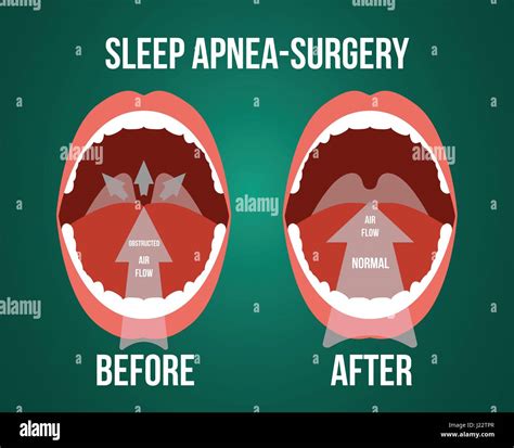 Vector Illustration Of Surgery For Obstructive Sleep Apnea Before And