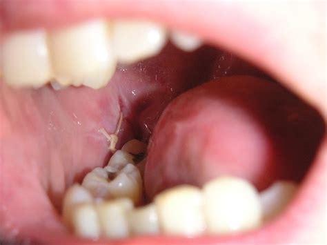 Stitches Dissolve After Wisdom Teeth Removal Teethwalls