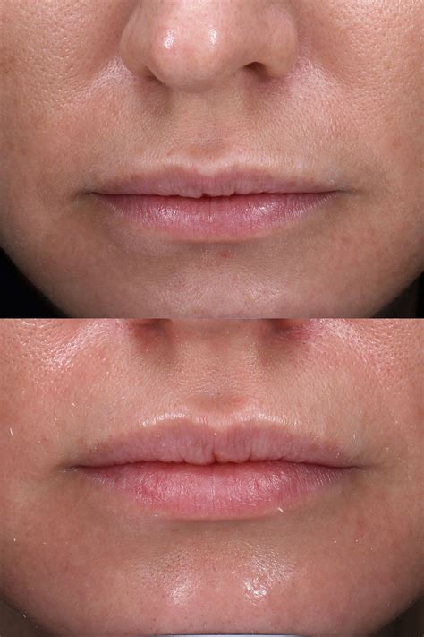 What To Expect After Botox Lip Flip Sitelip Org