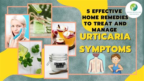5 Home Remedies To Treat Your Urticaria Fast And Effectively Youtube