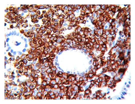 Hande 400× Sheets Of Atypical Round Cells Ihc Cd 117 Marker 400×