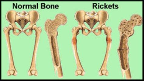 Rickets Types Symptoms And Treatments Goqii