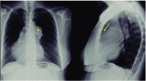 Posteroanterior Chest X Ray Showing A Dextropositioned Heart With
