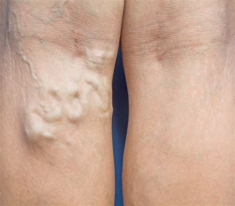 Varicose Veins In The Legs Colorado Laser Clinic Pc