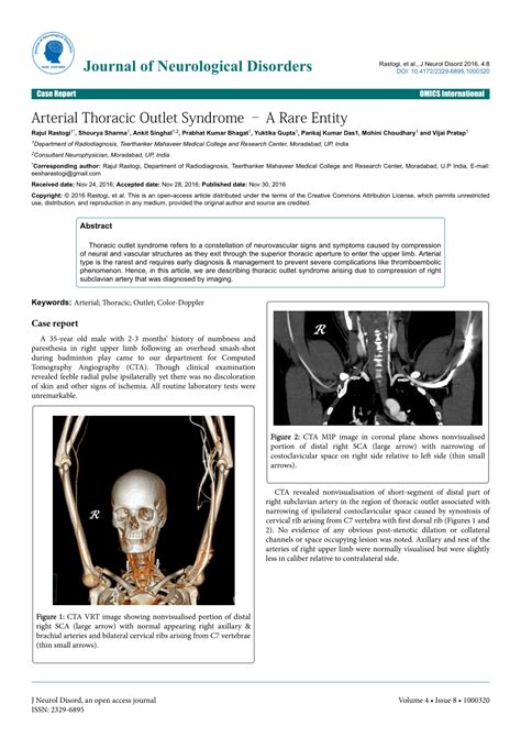 Pdf Arterial Thoracic Outlet Syndrome A Rare Entity