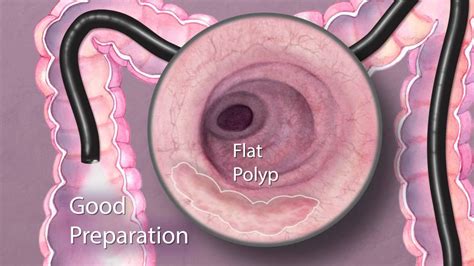The Importance Of Good Bowel Preparation During Colonoscopy Youtube