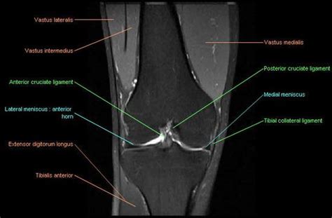 Knee Imaging Knee Sports Orthobullets