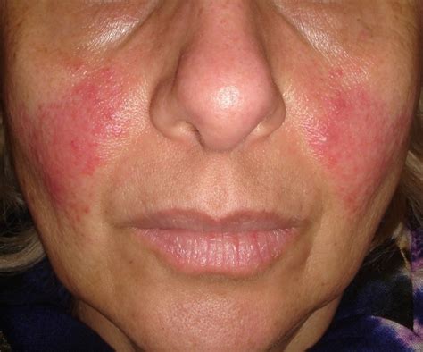 Patients With Rosacea Have High Prevalence Of Contact Sensitization To
