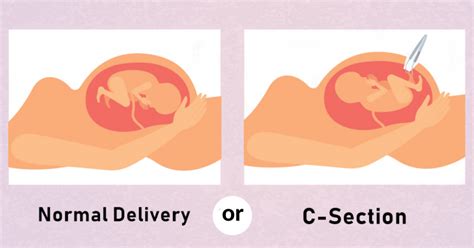 which delivery is better normal delivery or cesarean c section delivery yashoda hospital